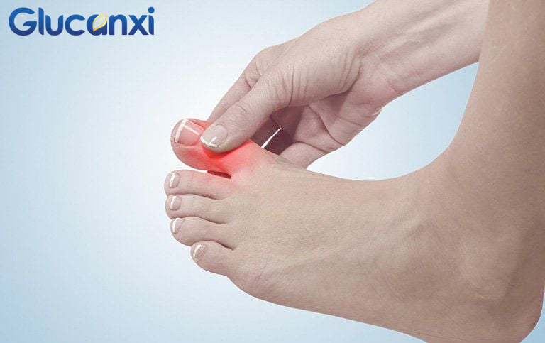 Một số dấu hiệu nổi bật của bệnh gout 