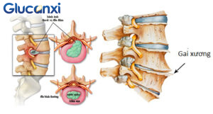 Tìm hiểu về bệnh gai xương